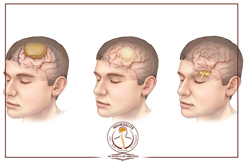 اعراض اورام المخ