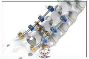 عملية تثبيت الفقرات