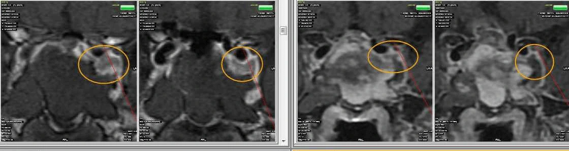 جراحة الغدة النخامية بالمنظار